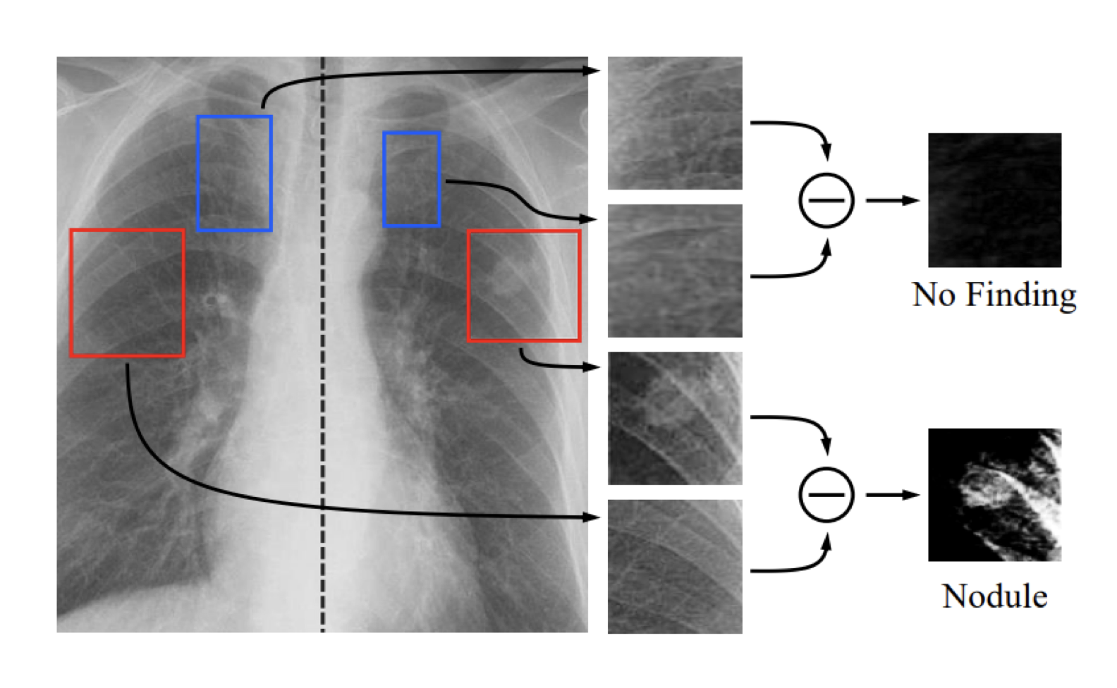 Chest x-ray